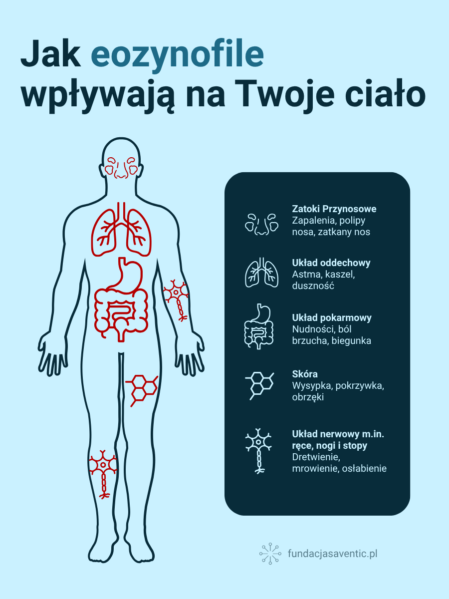 Infografika przedstawiająca sylwetkę człowieka z zaznaczonymi obszarami ciała dotkniętymi eozynofilią, w tym zatokami, płucami, przewodem pokarmowym, skórą i nerwami obwodowymi. Wymieniono objawy takie jak astma, ból brzucha, wysypka i drętwienie. Stworzone przez Fundację Saventic.