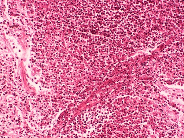 Histological image of lung tissue showing intense eosinophilic infiltration around a blood vessel with fibrinoid necrosis. This illustrates tissue damage caused by high eosinophil levels, as seen in EGPA.