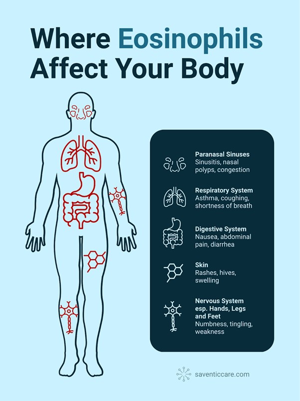 Infographic showing a human silhouette with highlighted body regions affected by eosinophilia, including the sinuses, lungs, digestive tract, skin, and peripheral nerves. Symptoms like asthma, abdominal pain, rashes, and numbness are listed. Created by Saventic Care.