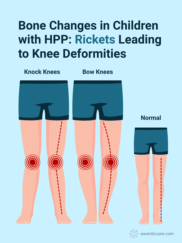Illustration of knock knees, bow knees, and normal legs in children with Hypophosphatasia (HPP) due to rickets.