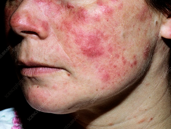 photo of a woman with rash across the cheeks and nose, one of the main signs of Lupus.